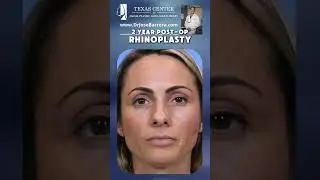 2-year post-op results for his female patient following Rhinoplasty & Septoplasty