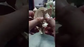 Temporal Bone part 3