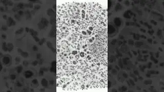 Reed sternberg cell and variants| Hodgkin lymphoma
