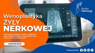 WENOPLASTYKA ŻYŁY NERKOWEJ Z EMBOLIZACJĄ ŻYLNĄ - jak przebiega zabieg?