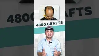 Hair Transplant Surgery in Siliguri | Baldness Treatment | New Roots #hairtransplant #shorts