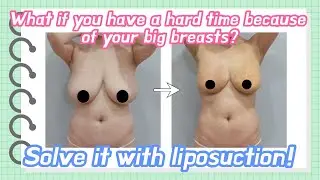 Are you struggling with large breasts? Solve it with liposuction!