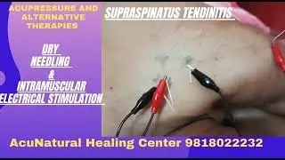 Supraspinatus Tendinitis Pain Management by Dry Needing and Intramuscular Electric Stimulation
