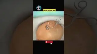 This is How fluid is drain from Skull.#cerebral ,#drainage,#brain