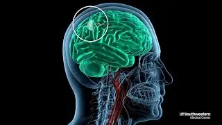 New study drives faster stroke response times