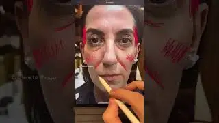 Caso transformador de harmonização facial pelo Dr Renato Maggio, incrível!