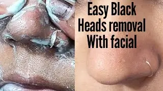 (Without Nose Pin📌) Easy Trick Black Heads Removal on Nose With Facial Tutorial/ Step by step