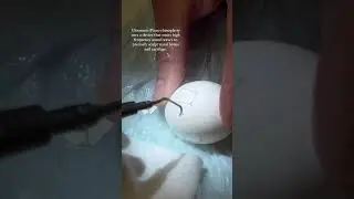 Ultrasonic (Piezo) Rhinoplasty on an Egg | 8 West Clinic - Vancouver, BC