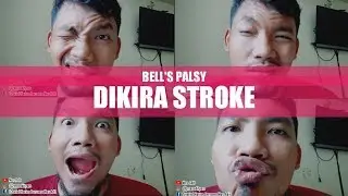Bell's Palsy - Muka Mencong Sebelah dan Cara Mengatasinya - Belpasy