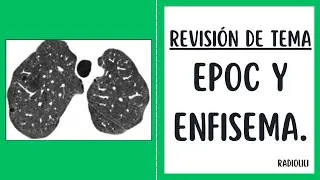 Revisión de Tema 57: EPOC y enfisema.