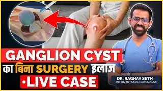 Live Ganglion Cyst Removal Case Without Surgery | Non- Surgical Treatment of Ganglion Cyst