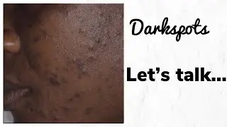 Darkspots | Anika M |