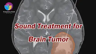 Sound Treatment for Brain Tumor | Healing Frequencies - Frequency Heals