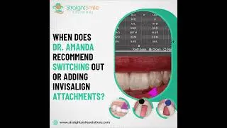 Invisalign Attachments- Changing them Out