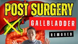 Life After Gallbladder Removal (The Real Recovery Nobody Talks About)
