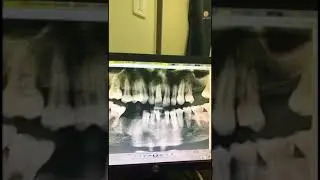 التهاب اللثة والأنسجة الداعمة للأسنان بسبب مهاجمة جهاز المناعة للبكتريا المحيطة بالأسنان بشكل مفرط