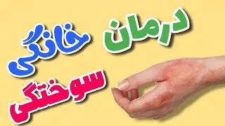 درمان خانگی سوختگی