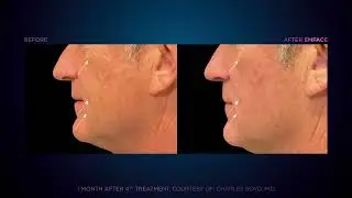 EmFace non-invasive face and neck rejuvenation in Louisville