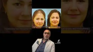 Reconstructive Hair Transplant following Cancer/Brian Surgery/Radiation/Chemotherapy