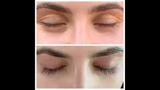 Latisse Before and After | FT. Careprost