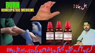 Burns: Causes, Symptoms & Treatment#burn#homeopathic#medicine#burnskin#burndegree