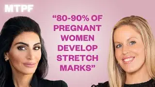 Stretch Marks: Causes, Prevention & Treatment Tips | More Than A Pretty Face Podcast