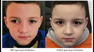 Operacija strabizma u specijalnoj bolnici Sveti Vid