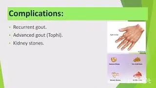 #bone disease gout disease of bone#youtube #trendingvideo#foryou #Adult health nursing 2 unit 1❤️