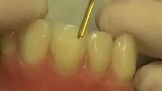 Direct Veneer Made Simple by Dr  Newton Fahl   Composite Restoration - XBD