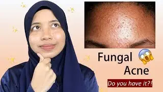 Everything You Need To Know About Fungal Acne!