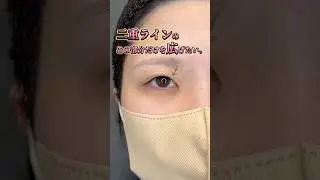 【蒙古襞があるけど目頭からしっかりした並行型二重にしたい方必見👀❣️】　#美容整形 #目頭切開 #二重整形