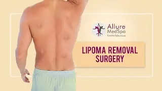 Multiple Lipoma Removal Surgery at Alluremedspa | Dr.Milan Doshi