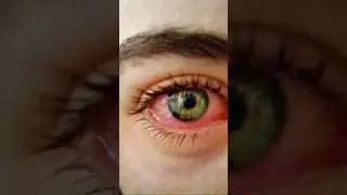Removing redness of eye #redness #eyes #photoshop