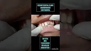 #whiteteeth #rct #how to get your teeth replacement after broken tooth? #dentist #smiledesigndental