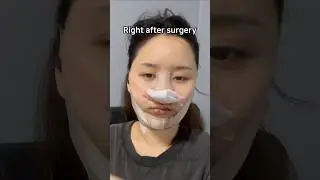 I completely transformed into an influencer just with nose surgery! #shorts #fyp #glowup #korea