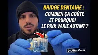 💰 Beaucoup de patients me demandent 👉 &ldquo;C&rsquo;est combien un bridge dentaire ? Pourquoi &ccedil;a varie autant?