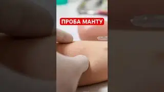 Проба манту #vtrepal