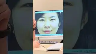 Double Eyelid Surgery | Eyelid Surgery | Plastic Surgery Before & After Transformation