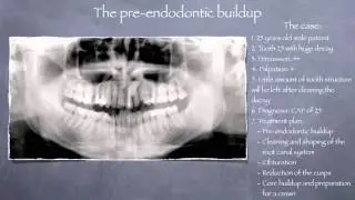Pre-endodontic buildup