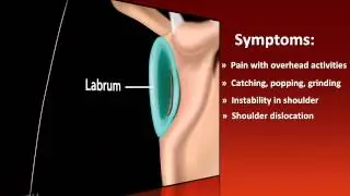 USC Athletics Injury Report - Shoulder Labral Tear