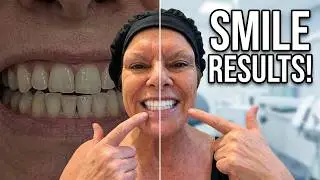 Part 5- My Journey With Smile Direct Club .First 4 Videos Are The Shorts Videos.