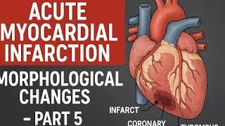 Acute myocardial infarction morphological changes - part 5