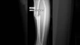 From X-ray to Surgery: Complex Tib-Fib Leg Fractures⁉️
