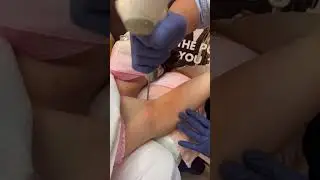 UNDERARM LIGHTENING LASER