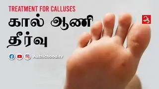 கால் ஆணி தீர்வு | Calluses treatment in Tamil homeopathy | Dr Vidhya | Aathichoodi