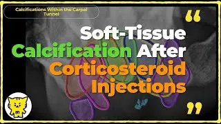 Carpal Tunnel Syndrome_Soft-Tissue Calcification After Corticosteroid Injections