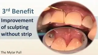 Cosmetic Composites - Achieving Great Contours and Contacts with the Mylar Pull