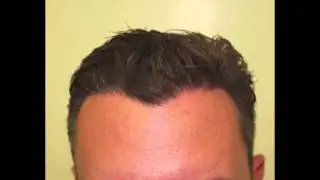 Haartransplantation Haarverpflanzung FUE 1200 Grafts Dense Packing