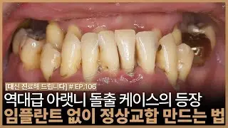 [대진다] 가려져서 그렇지 '윗니'있습니다..│부정교합, 반대교합, 주걱턱, 앞니보철, 크라운, 상악동 이식수술, 임시치아, 보철치료│EP.106