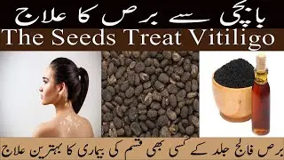 Babchi Se Bars Ka Ilaj | Bakuchi Seed Oil For Vitiligo | Bafqarosha Ki Hikmat